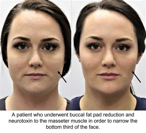 Buccal Fat Pad Reduction .